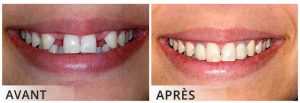 resultat implant dentaire Turquie 