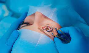 chirurgie réfractive turquie