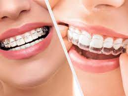 Différence entre Invisalign et appareils orthodontiques traditionnels